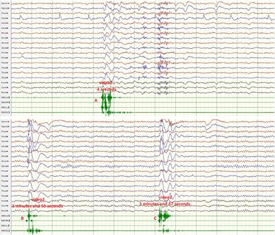 Clinical Features and Prognosis in Chinese Patients With Dipeptidyl–Peptidase–Like Protein 6 Antibody–Associated Encephalitis